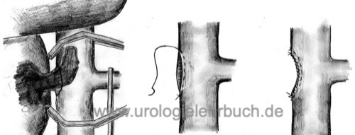 Abbildung: Tumornephrektomie mit infrahepatischem Tumorthrombus