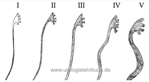 Abbildung Klassifikation des vesikoureteralen Refluxes anhand der Untersuchungsergebnisse im MCU