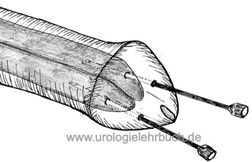 Abbildung Winter-Shunt zur Therapie des Priapismus