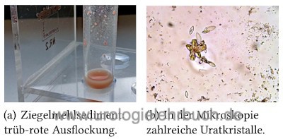 Abbildung Calciumoxalat-Kristalle im Urinsediment