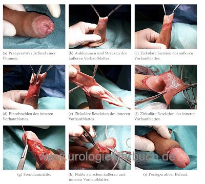 Erfahrungsberichte beschneidung mann Beschneidung (Beschneidung)