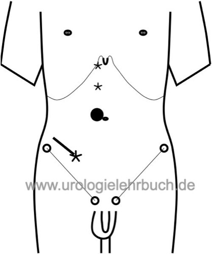 Abbildung Trokarpositionen bei der laparoskopischen Nephrektomie rechts