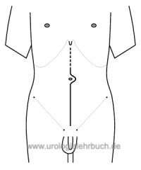 Abbildung Urologische Operation