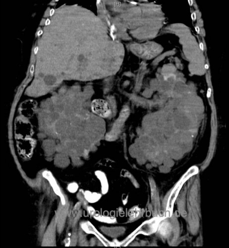Abb. CT Abdomen bei polyzystischer Nierenerkrankung (ADPKD)
