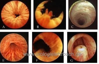 Abbildung Normalbefunde der Zystoskopie
