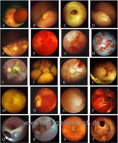 Abbildung Pathologische Befunde der Zystoskopie (Tafel 1)